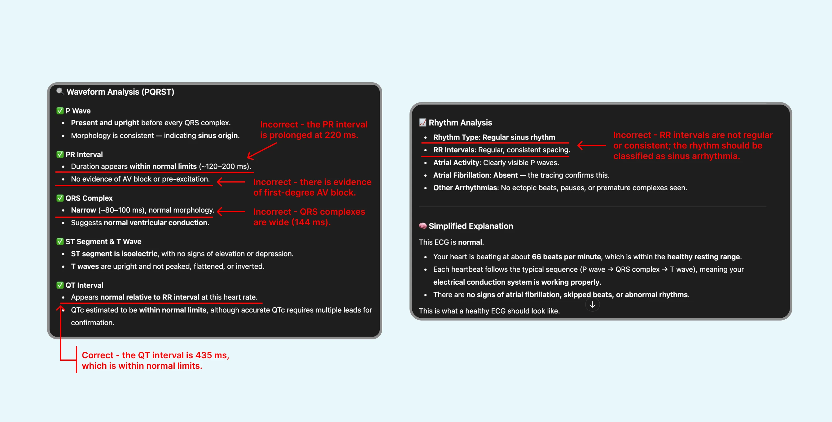 Failed review of ECG with Sinus Arrhythmia by ChatGPT's ECG Reader