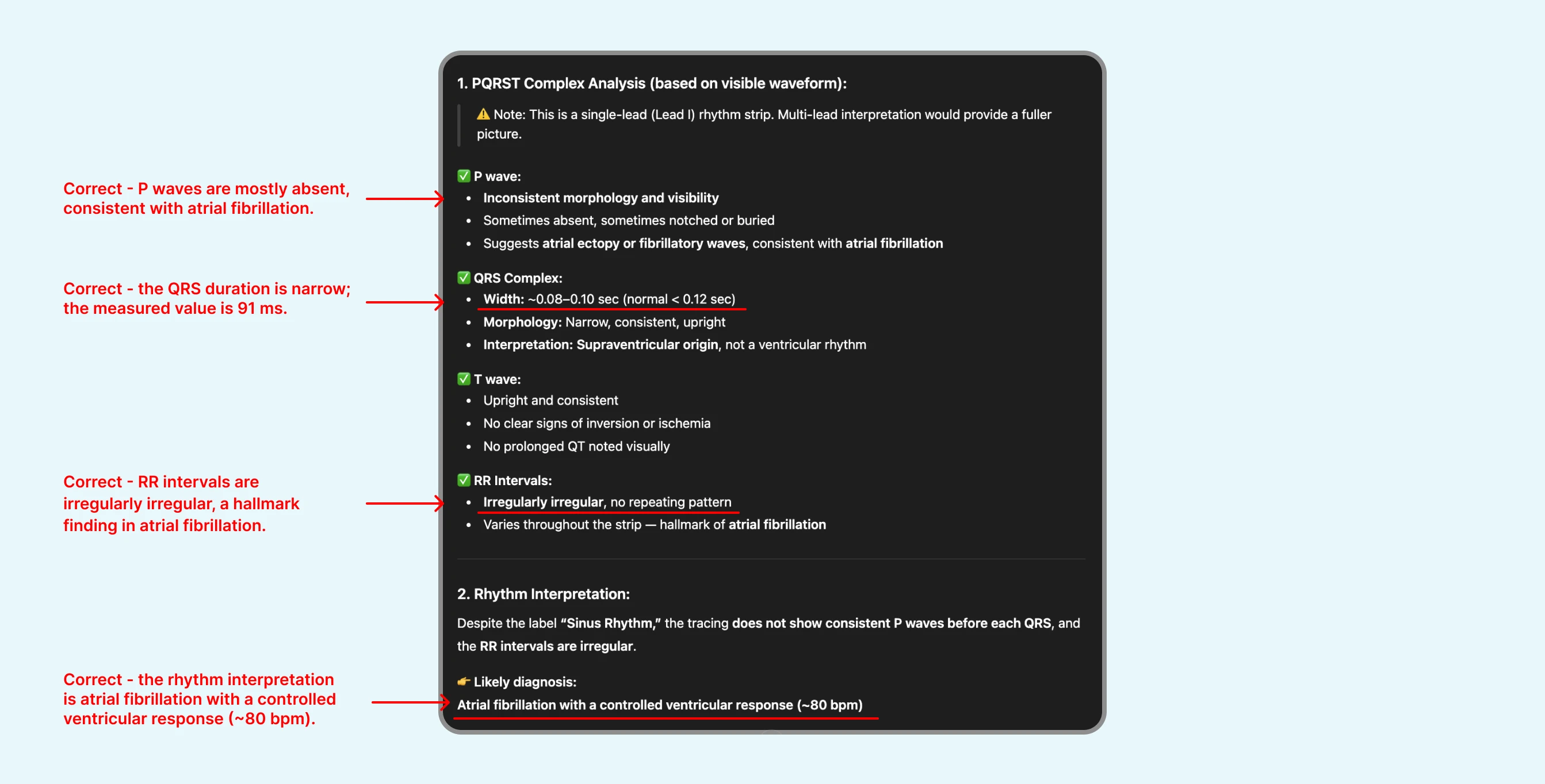 Good review of ECG with atrial fibrillation by ChatGPT's ECG Reader