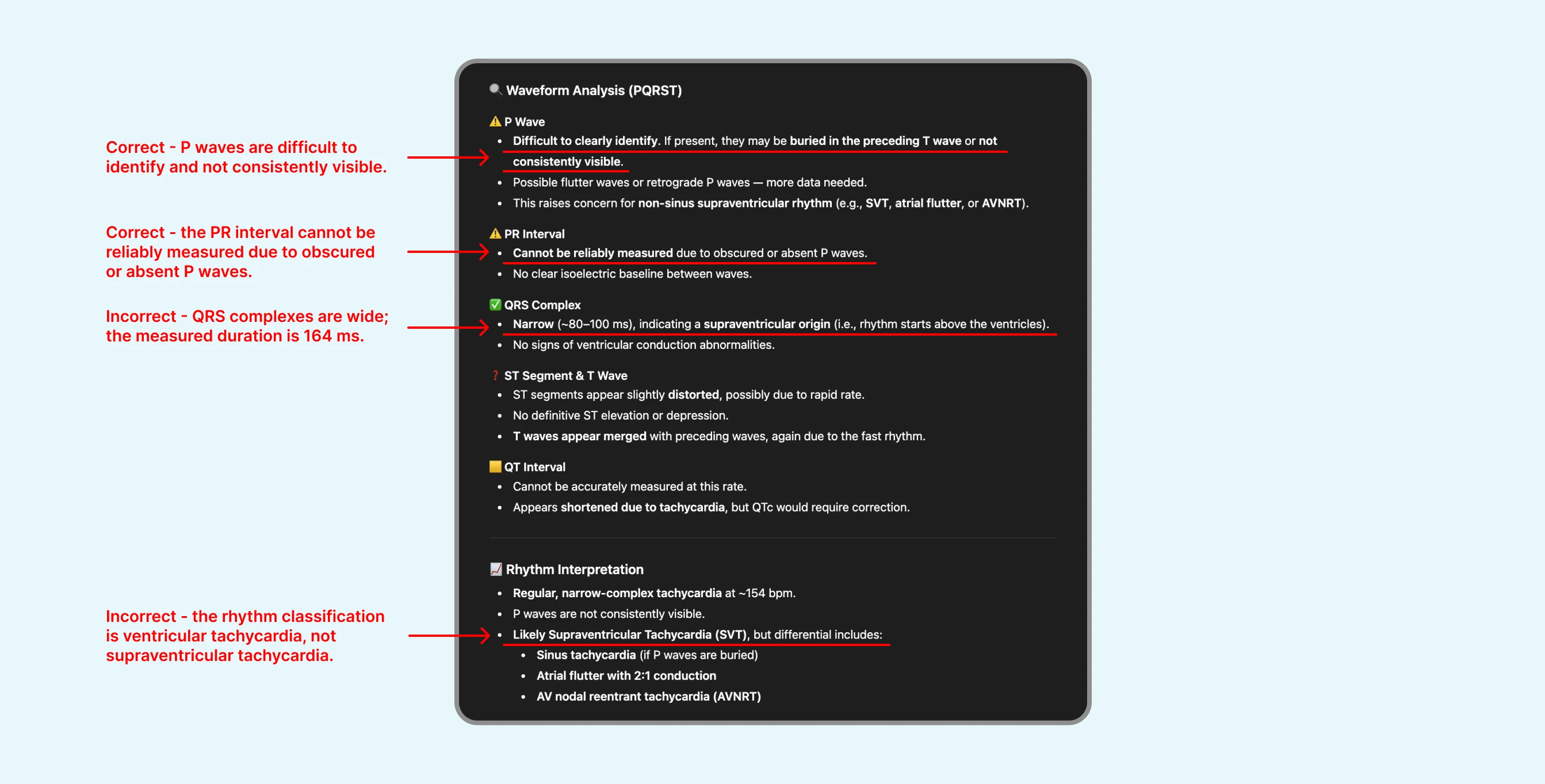 Good review of ECG with ventricular tachycardia by ChatGPT's ECG Reader