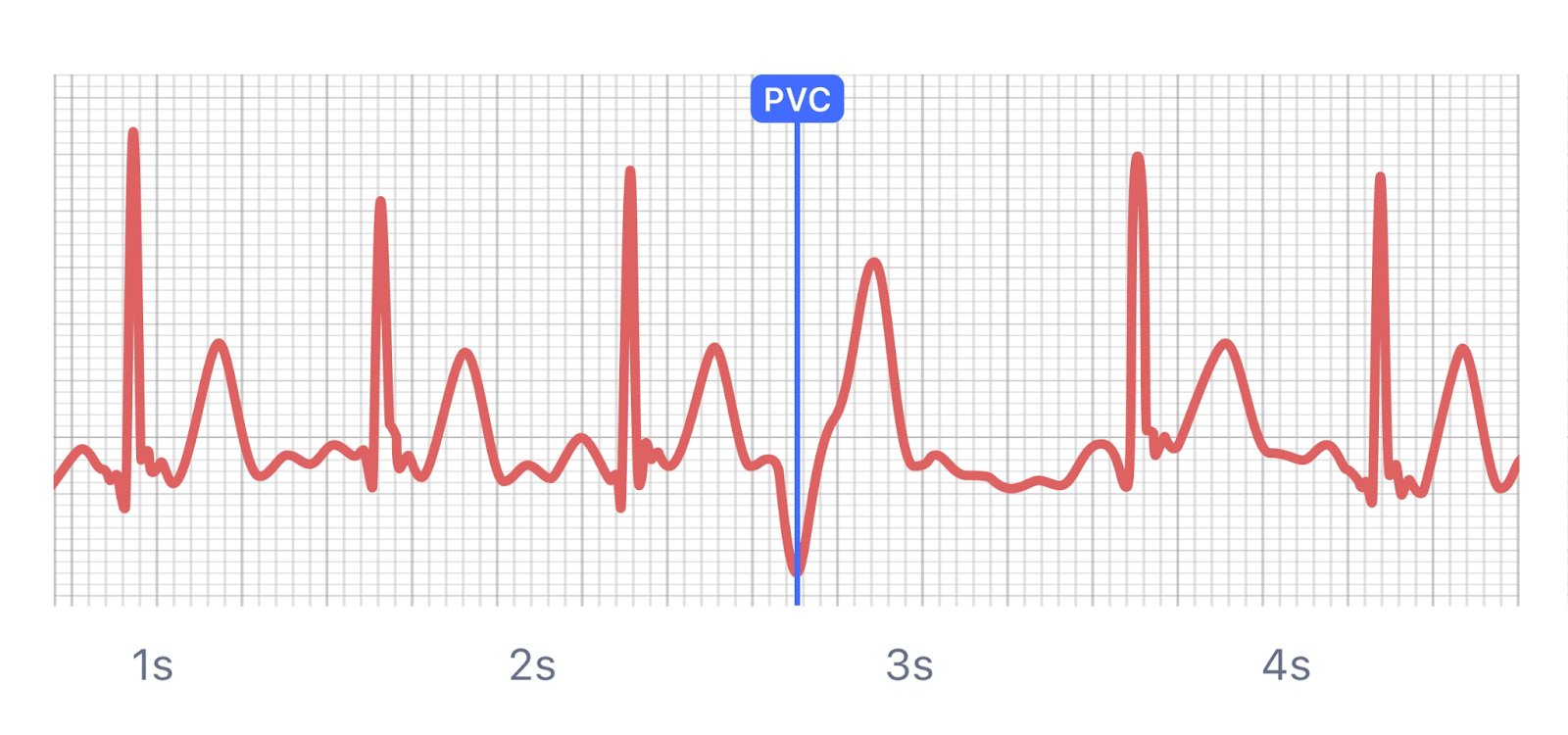 An ECG waveform on a grid, showing several heartbeats and one PVC marked at 2.75 seconds.