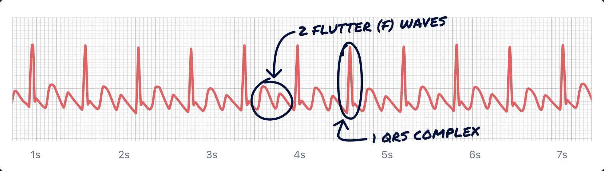 An ECG rhythm strip displaying atrial flutter with labeled F waves and QRS complexes.