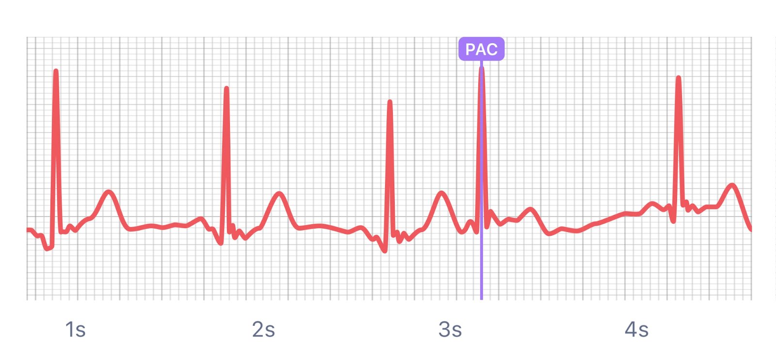 An electrocardiogram (ECG) display showing a heart rhythm, with a PAC (Premature Atrial Contraction) highlighted around 3.2 seconds.