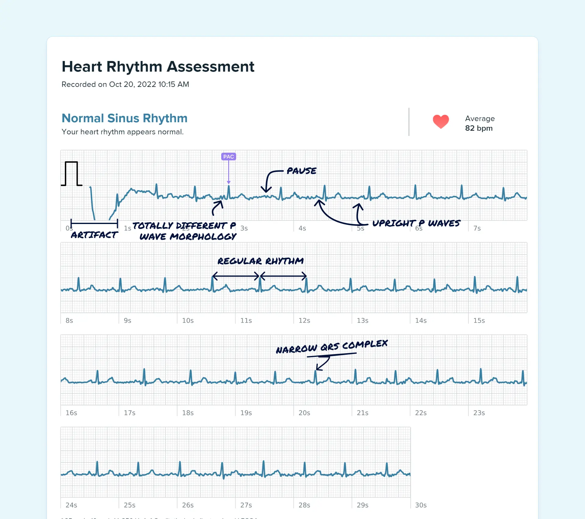 PAC read on a Fitbit ECG through the Qaly app.