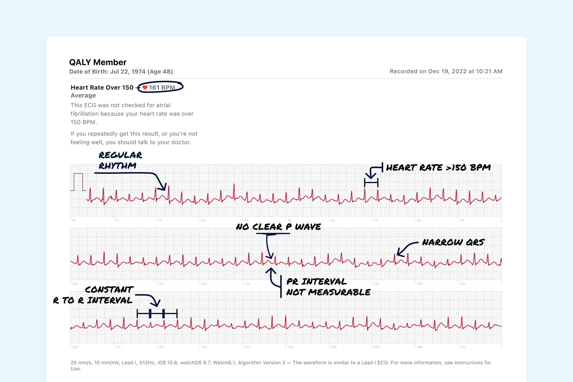 Sustained SVT read on an Apple Watch ECG through the Qaly app.