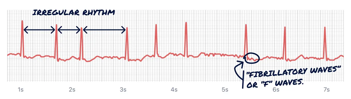 Here's Afib caught on a Qaly member's Apple Watch ECG. Tell-tale signs include an irregularly irregular rhythm and fibrillatory waves.