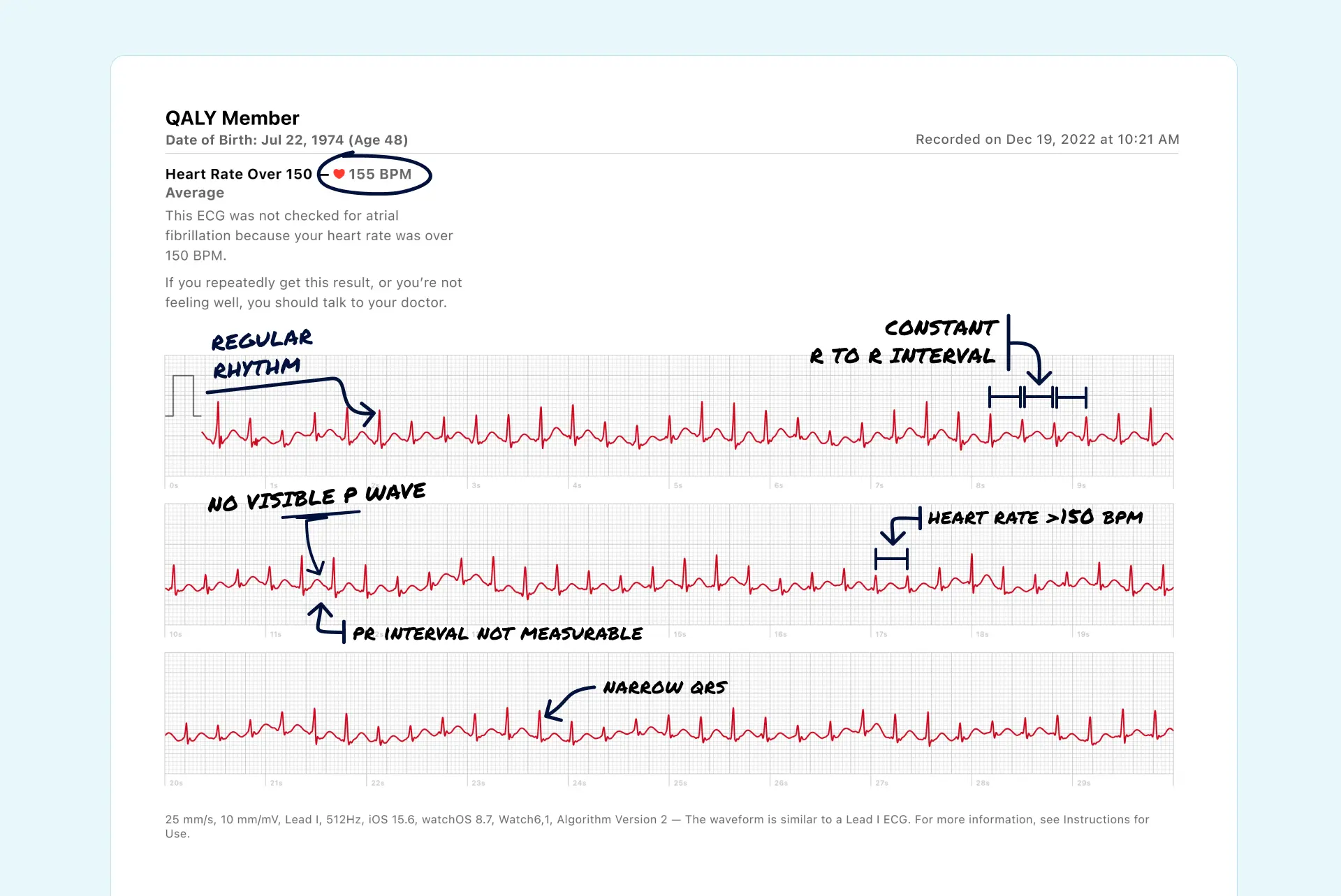 SVT read on an Apple Watch ECG through the Qaly app.