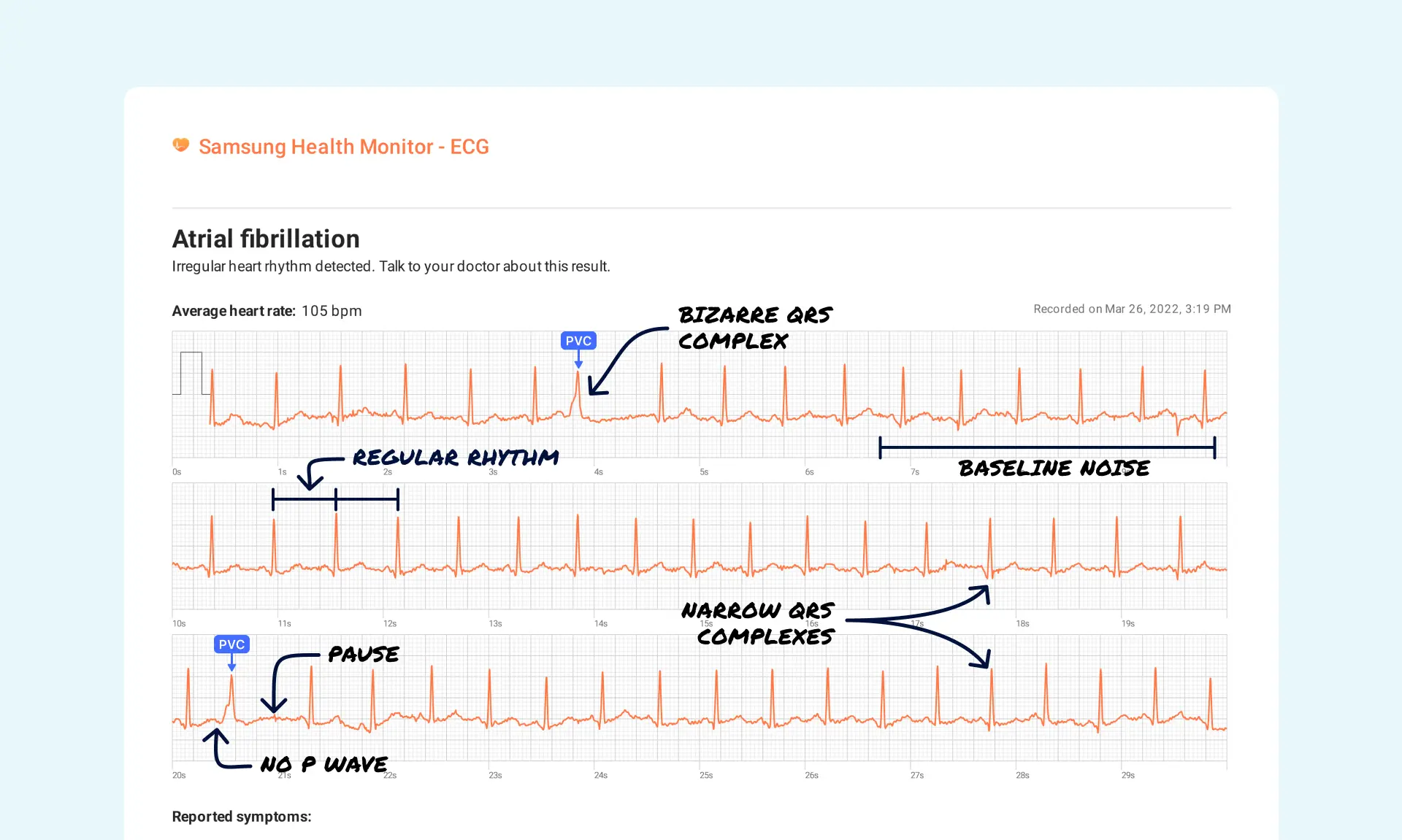 PVC vs ventricular couplet, samsung watch, samsung watch ecg