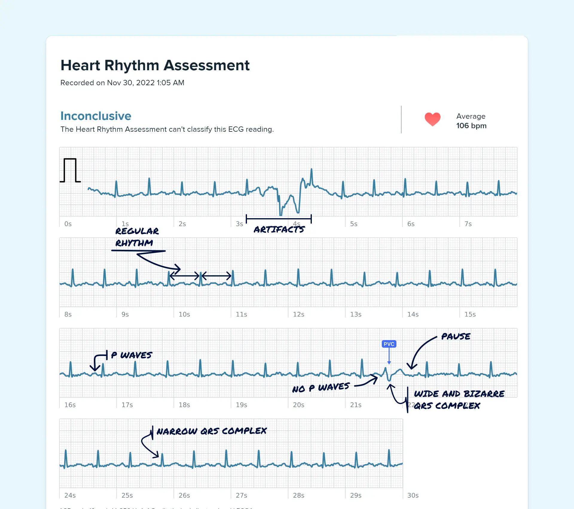 PVC read on a Fitbit ECG through the Qaly app.