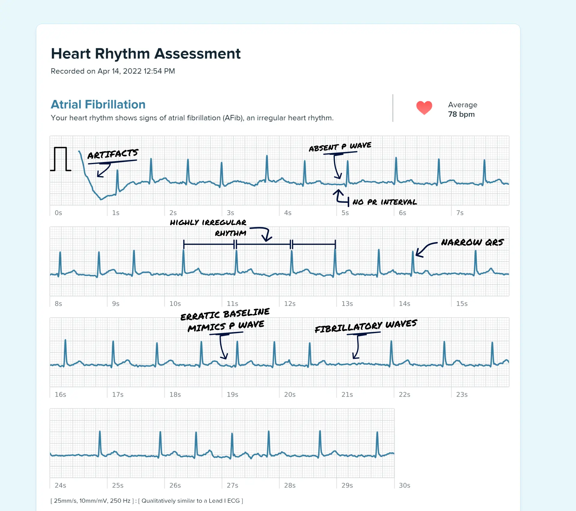 Afib read on a Fitbit ECG through the Qaly app.