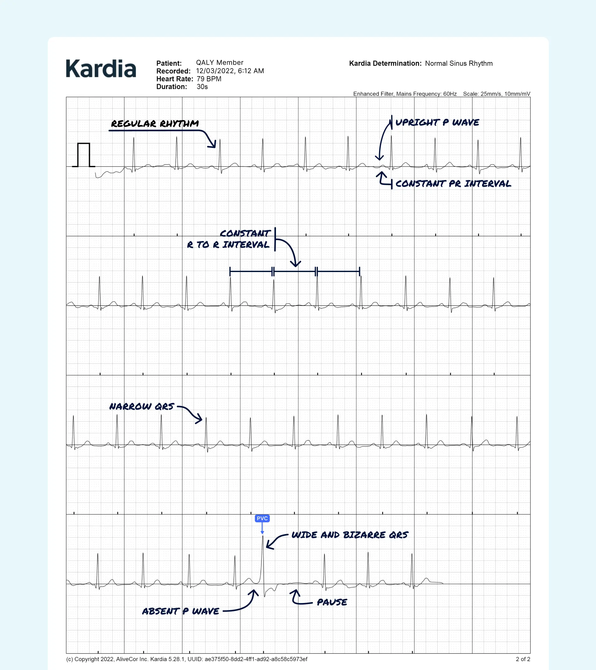 PVC read on a Kardia ECG through the Qaly app.