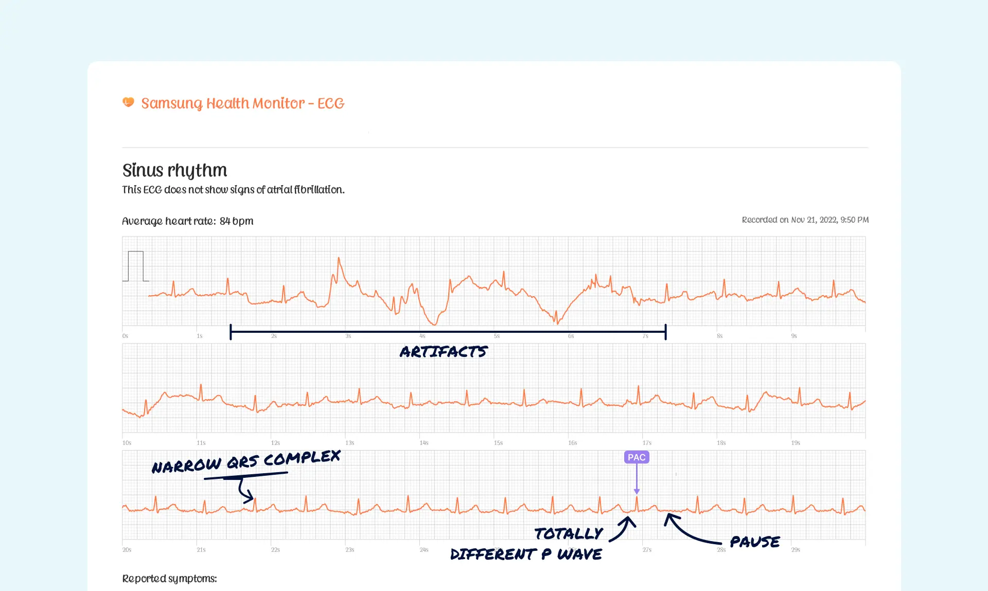 PAC read on a Samsung Watch ECG through the Qaly app.