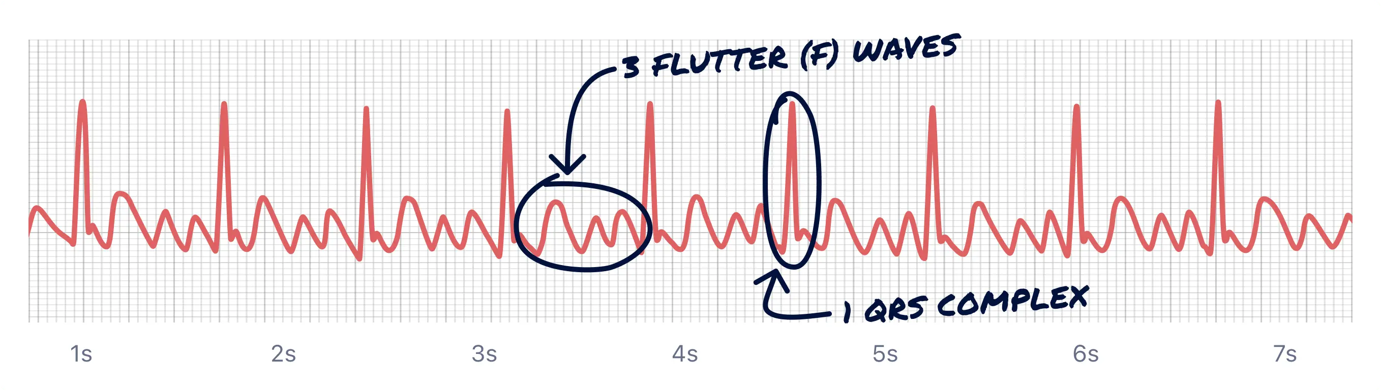 Here's Atrial Flutter with 3:1 ratio of F waves to QRS complexes. You can see the sawtooth even more clearly here.