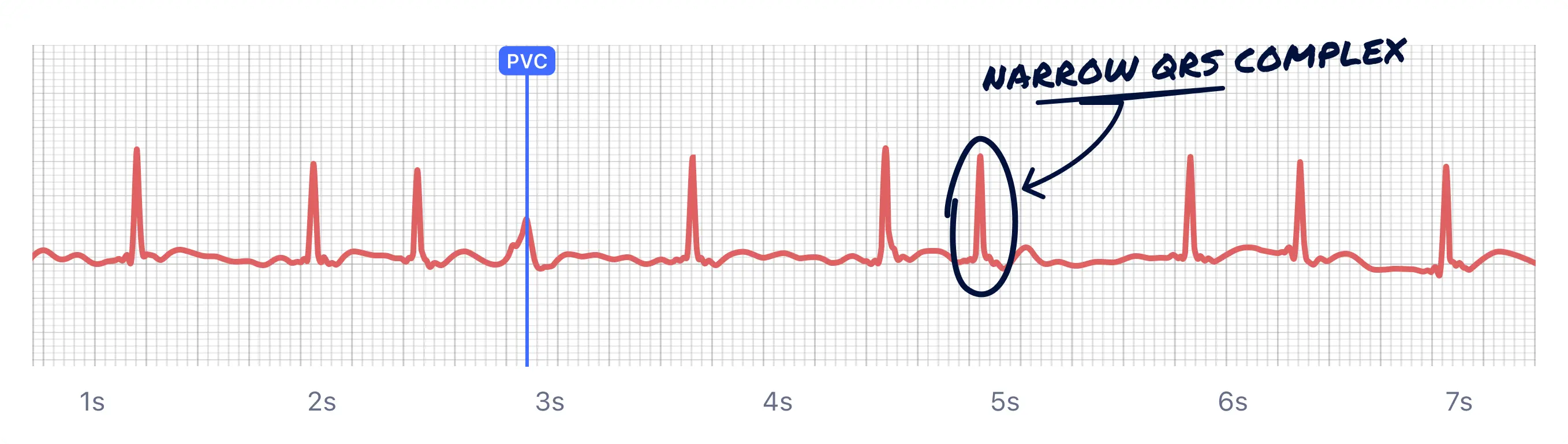 Here's another Atrial Fibrillation episode caught on a Qaly member's Apple Watch ECG, with an ectopic PVC to boot.