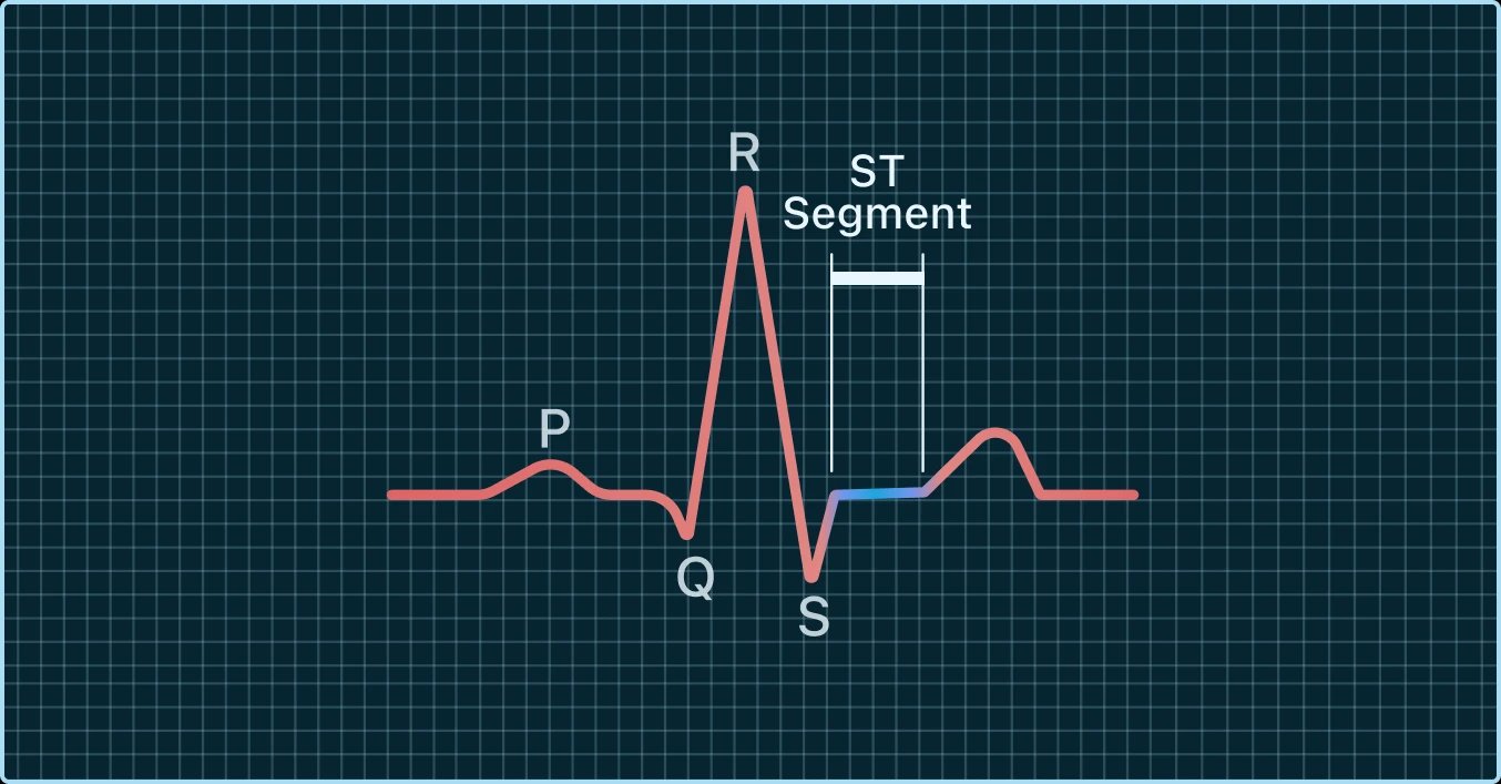 An ECG waveform on a grid, illustrating the P, Q, R, S waves and the ST segment.
