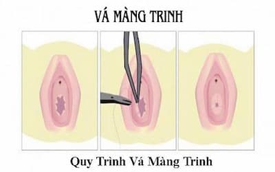 Hình ảnh vá màng trinh