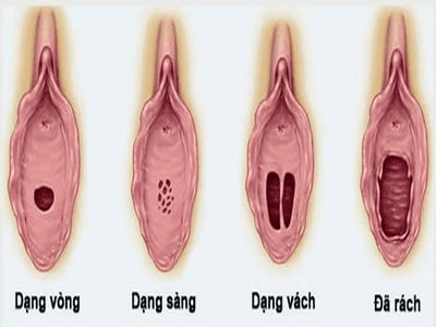 Hình ảnh minh họa màng trinh