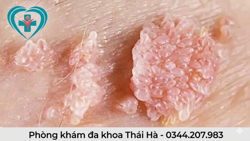 Bệnh sùi mào gà