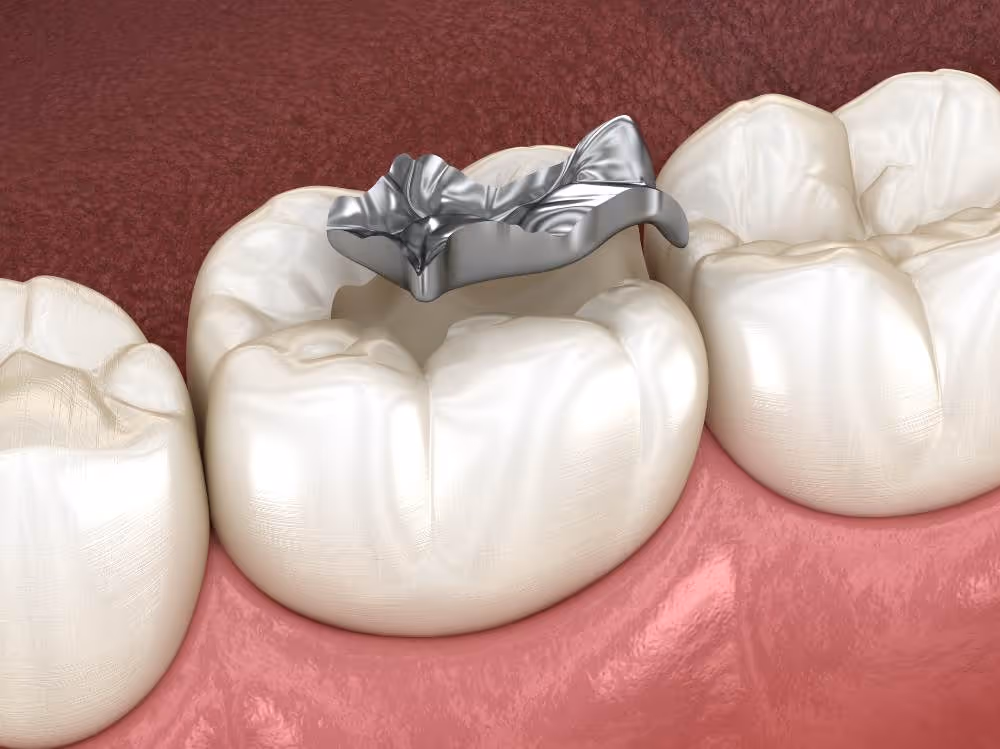 Silver Diamine Fluoride