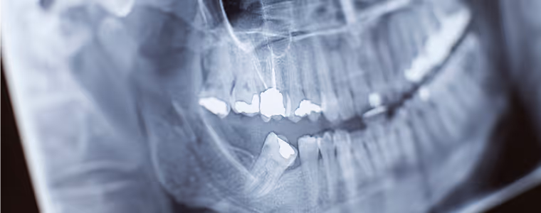 Röntgenaufnahme eines menschlichen Kiefers mit mehreren Zahnfüllungen und einem schräg verlaufenden Weisheitszahn.