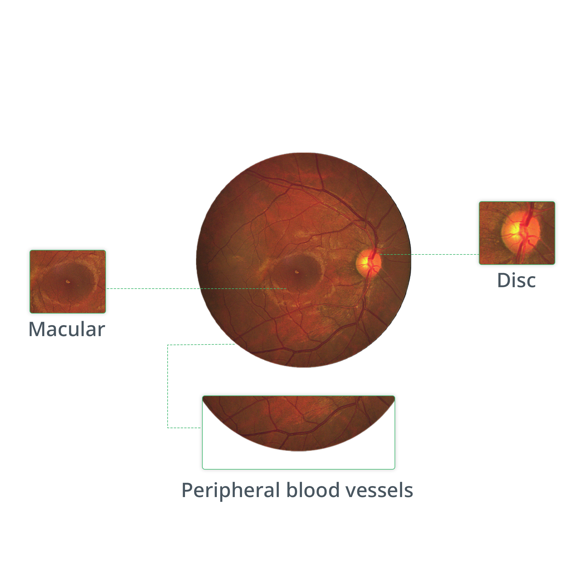 diabetic retinopathy fundus image