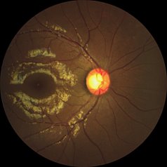 Retinal image