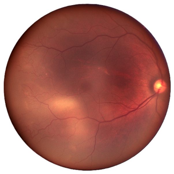 internal fixation & auto montage fundus image
