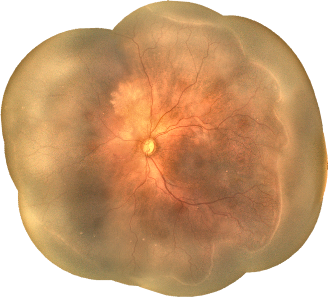 remidio retinal camera