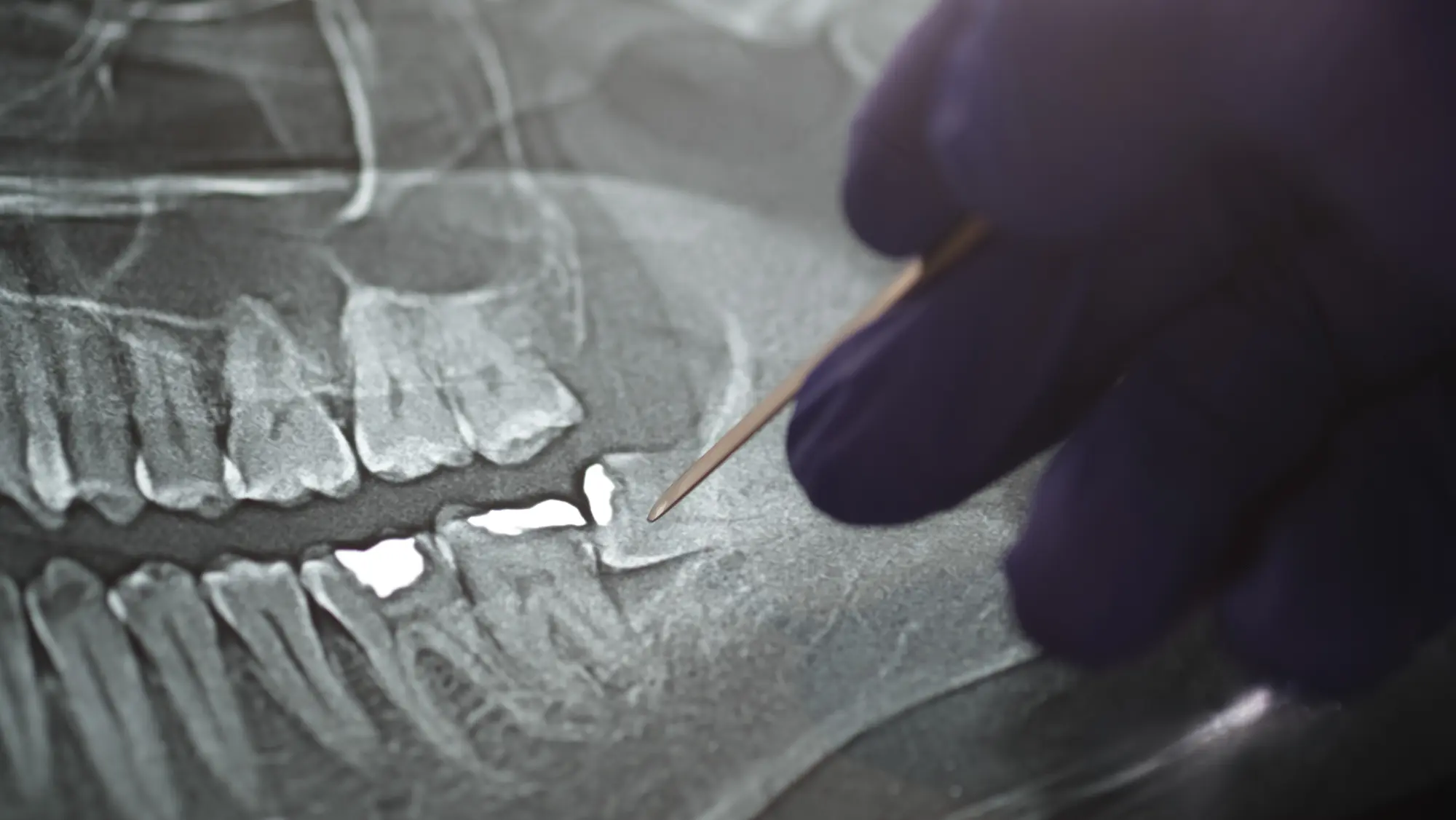 Understanding Sealants: The Best Time to Protect Molars