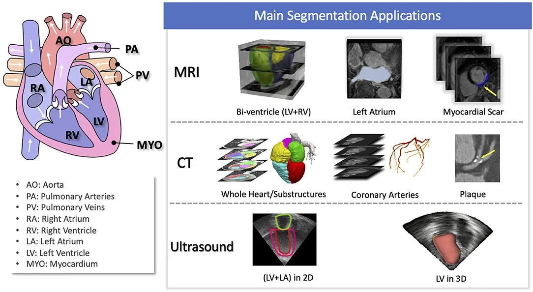 Overview of cardiac image segmentation tasks for different imaging modalities (Wikimedia Commons | CC BY-SA 3.0)
