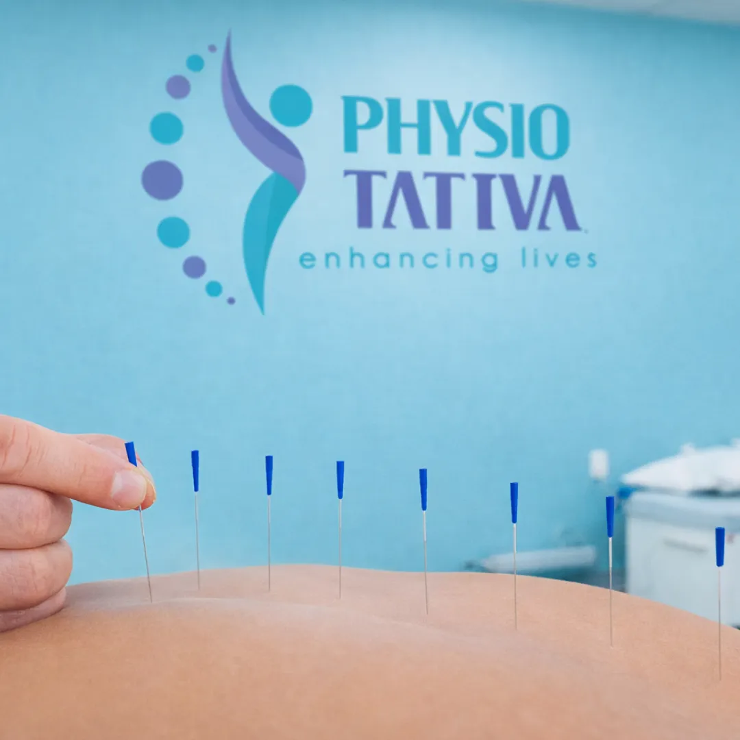 Dry Needling Therapy