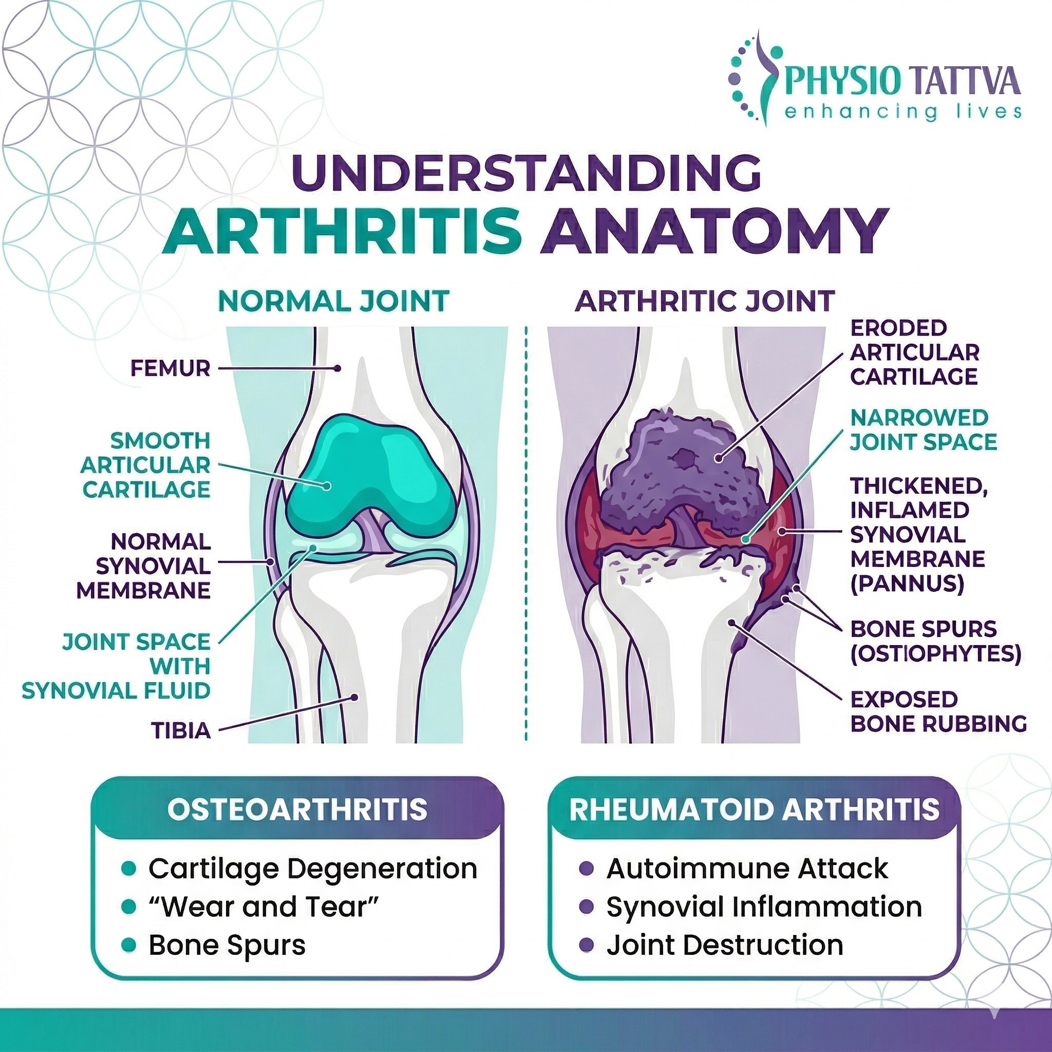 Understanding Arthritis - Poster Anatomico Laminato Su Artrite Reumatoide E Osteoartrite - 50x65 Cm - Plastica Resistente