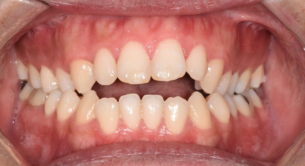 before and after treatment