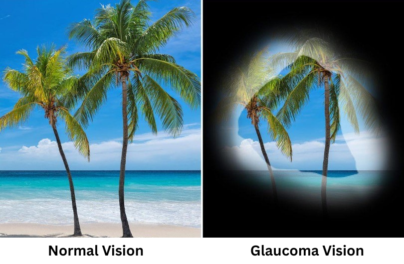Side-by-side comparison showing normal vision and vision loss caused by glaucoma, with tunnel vision effect.