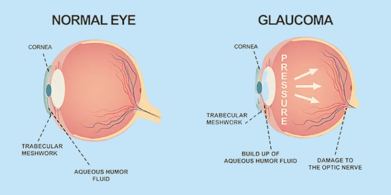 Medical illustration comparing a normal eye with an eye affected by glaucoma, showing fluid build-up and pressure on the optic nerve.