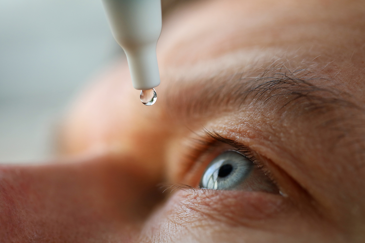 Close-up of a person applying glaucoma eye drops as part of treatment to lower eye pressure.