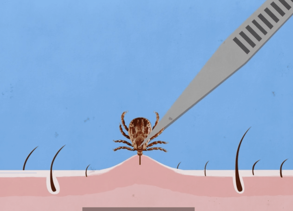 How to remove ticks