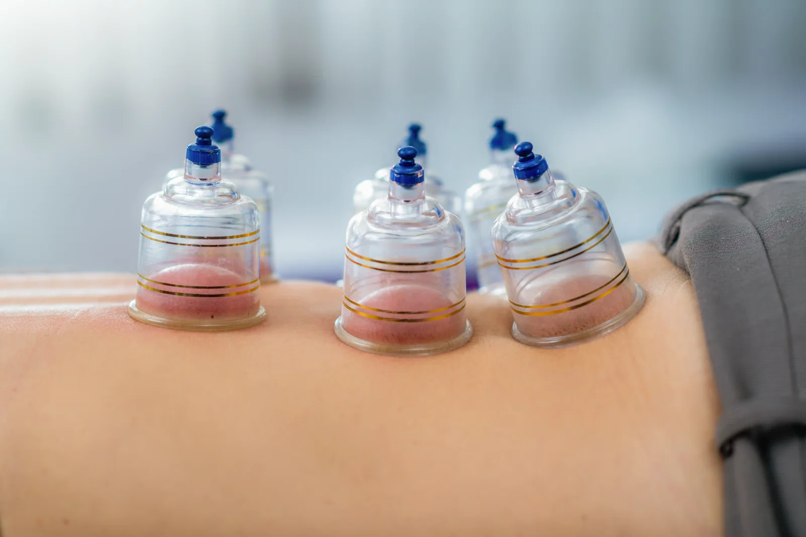 Cupping