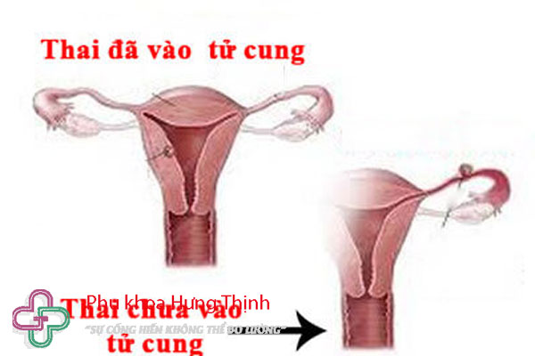 Thai chưa vào tử cung thì nằm ở đâu?