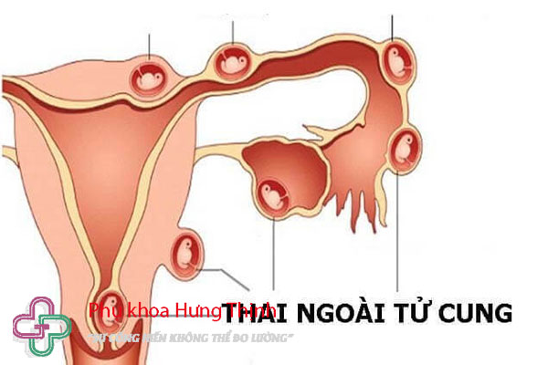 Thai ngoài tử cung có nguy hiểm không?