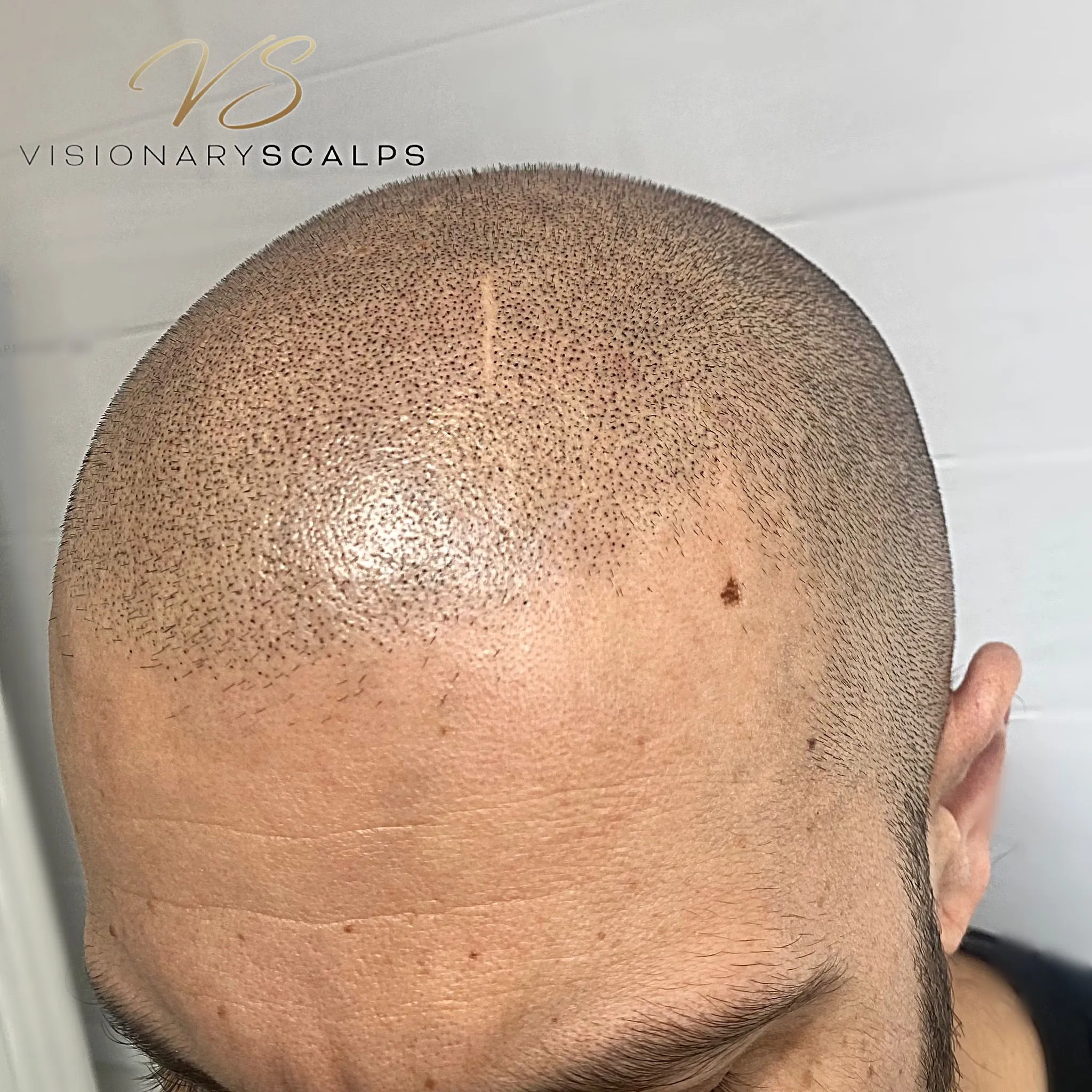 Hair Transplant Scars