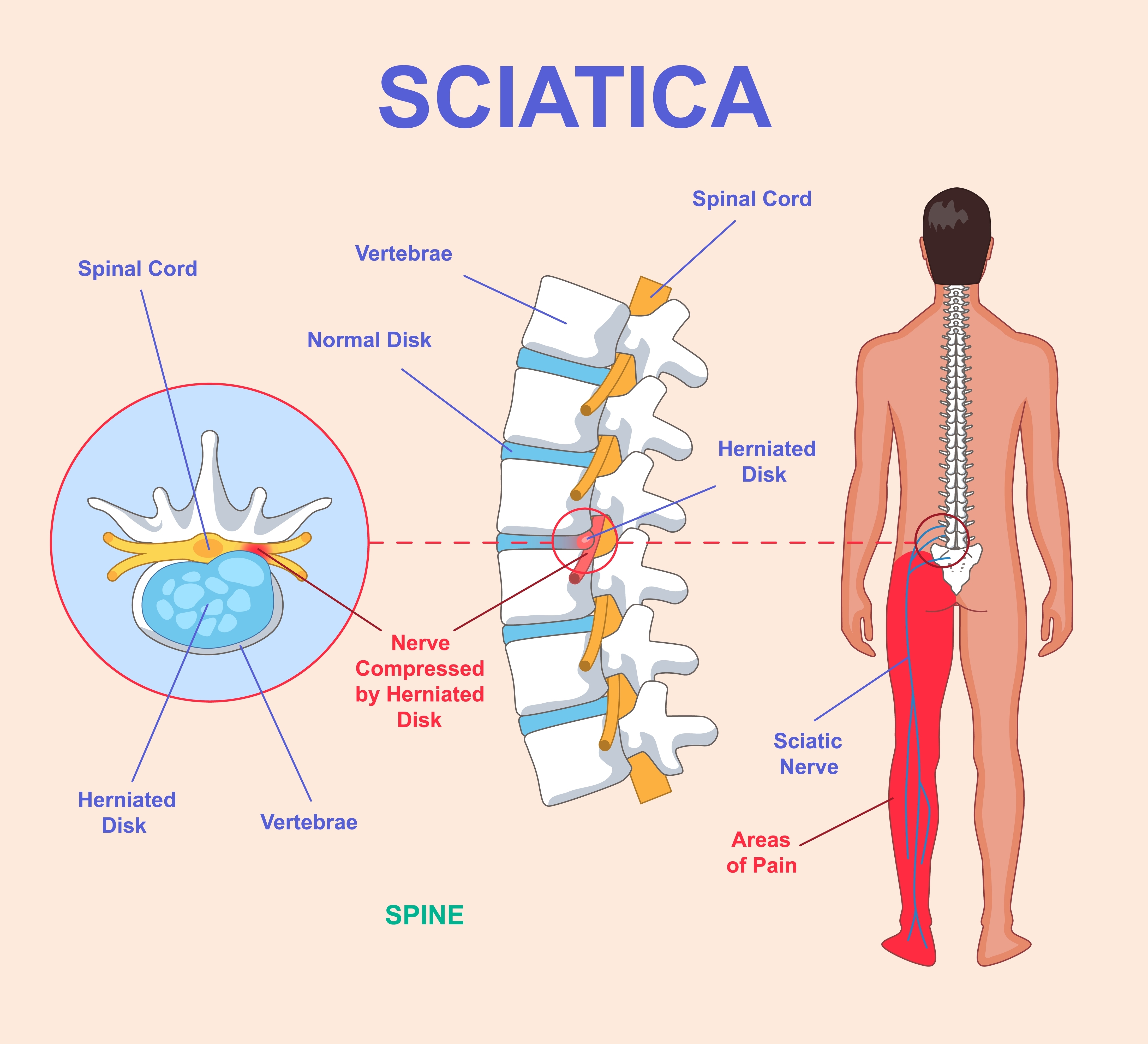 Whats the best way to treat sciatica