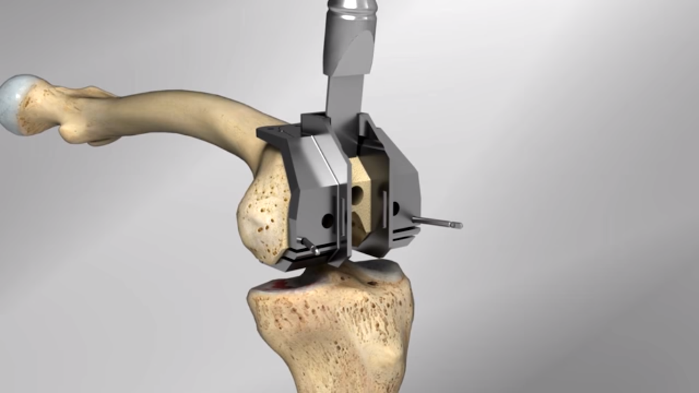 Protocolo Signatura Zimmer Biomet en la rodilla
