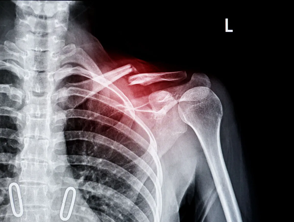 Fractura de clavícula