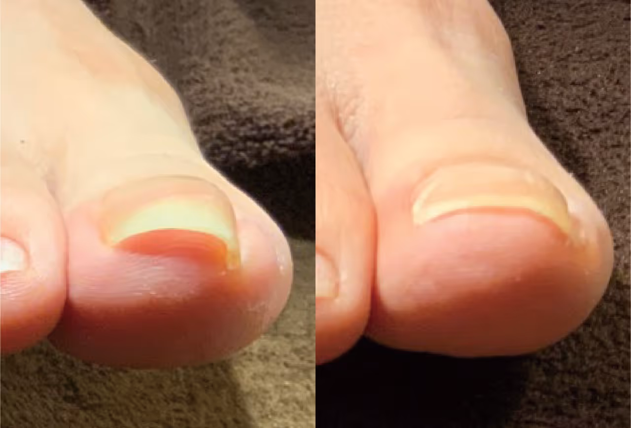 巻き爪施術の実績写真