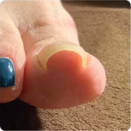 巻き爪の症例イメージ