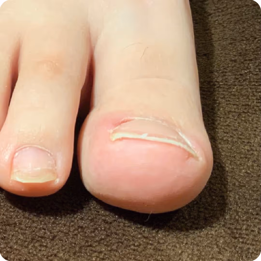 巻き爪の症例イメージ
