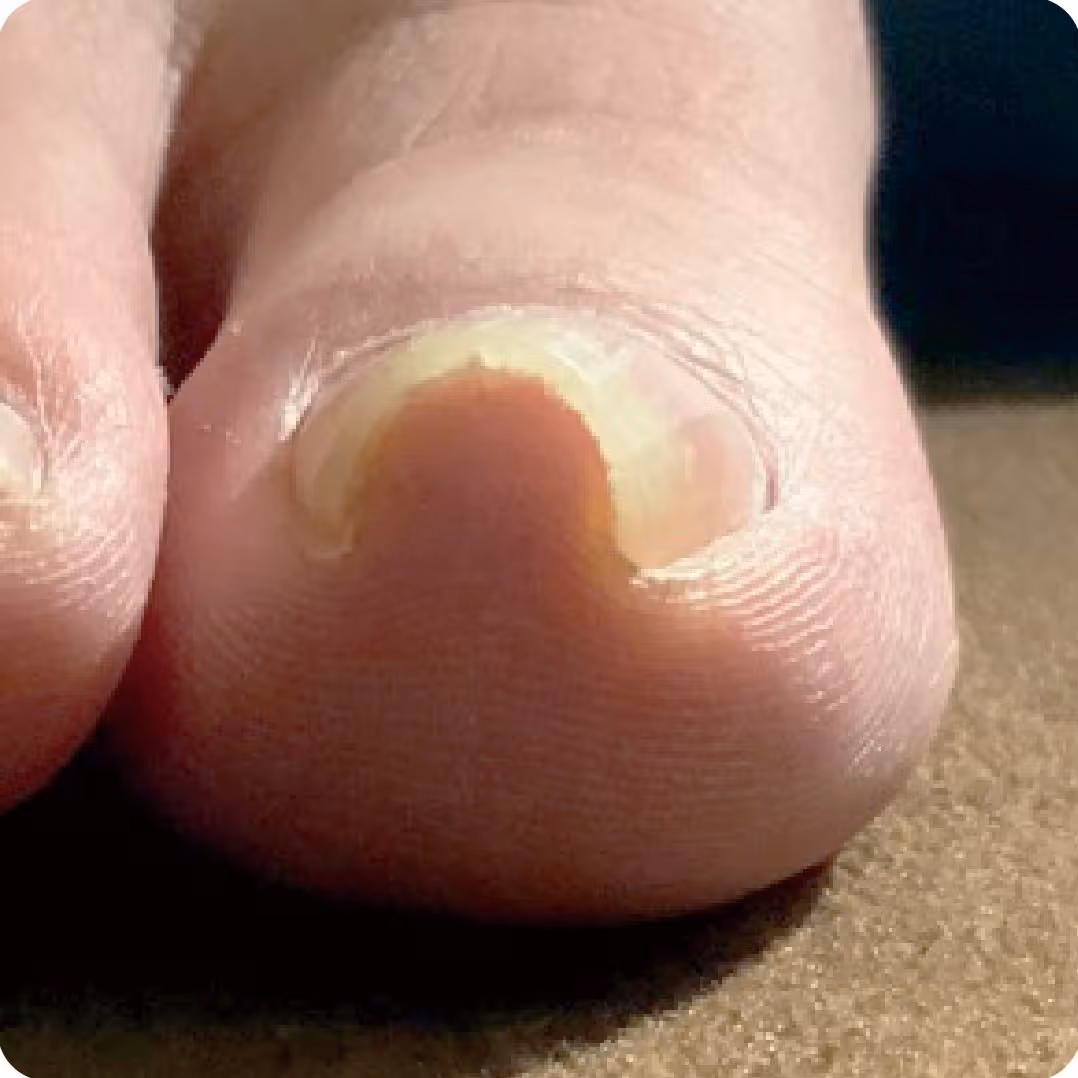 巻き爪施術の実績イメージ