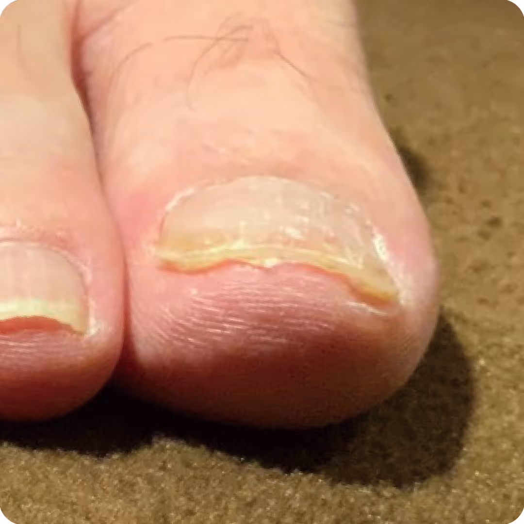 巻き爪施術の実績イメージ