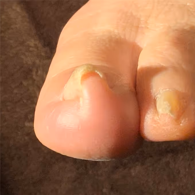 巻き爪の症例イメージ