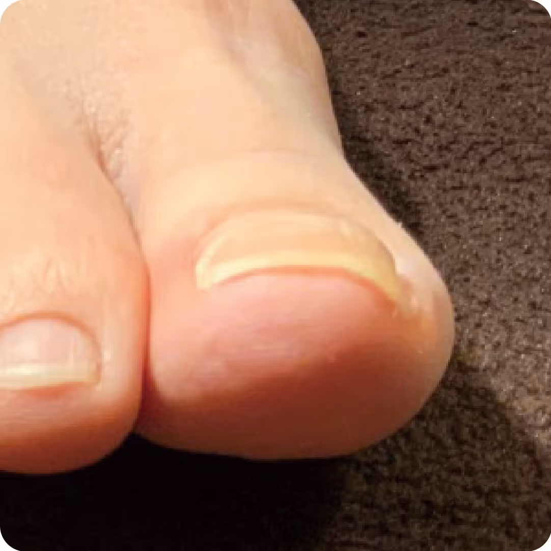 巻き爪施術の実績イメージ